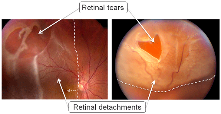 Retinal tears and retinal detachments