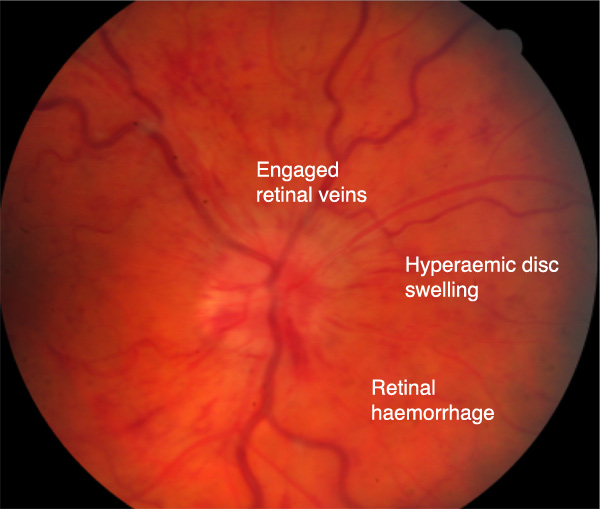 central retinal vein occlusion