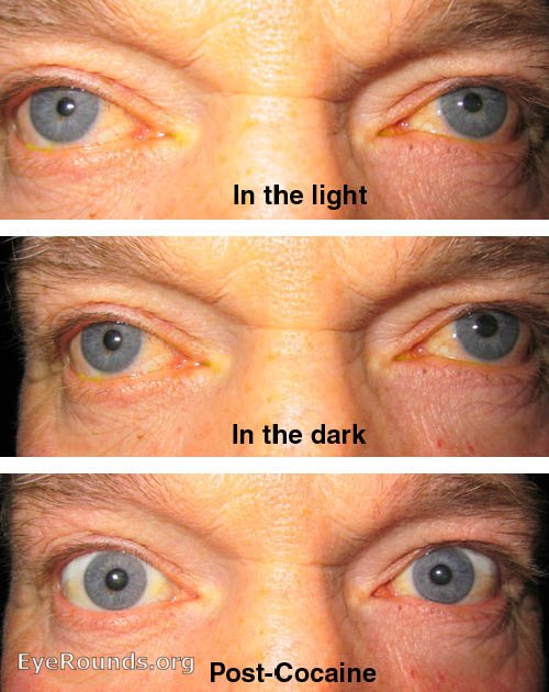 Physiological Anisocoria - in the light and in the dark
