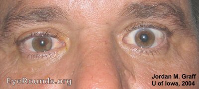 photo of man with Horner's syndrome