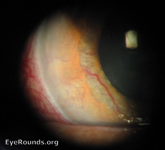 Photo showing new blood vessels on the surface of the iris