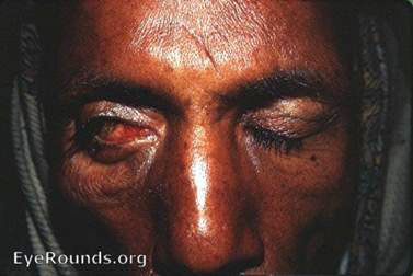 Photo of a patient with Bell's palsy. which can be seen by the upward and outward position of this patient's right eye.