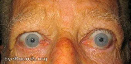 Photo of a patient with proptosis (most common cause is thyroid eye disease)