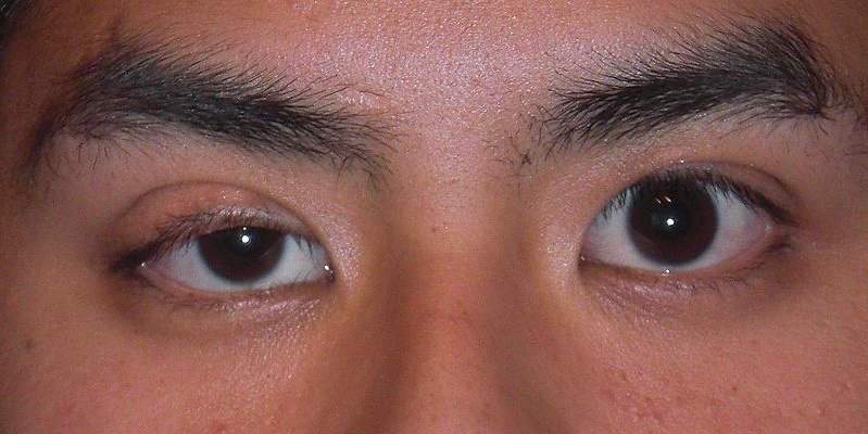 Example of Ptosis