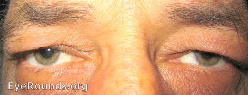 Folds of skin over an old man's upper eyelids