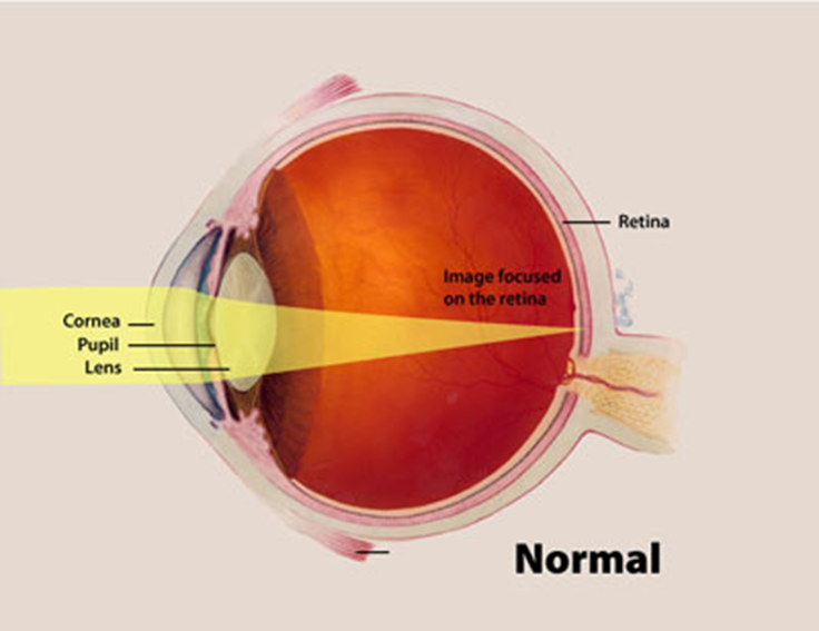Emmetropia (Normal Sight) - Parallel light from a distant object focuses on the retina and the image is seen clearly. When an object does not focus on the retina this refractive error is termed ametropia.