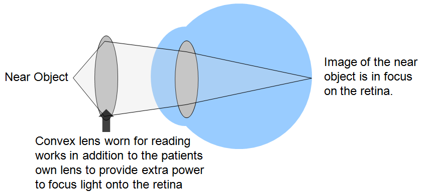 presbyopia correction