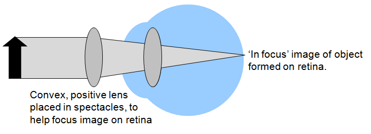 hypermetropia correction