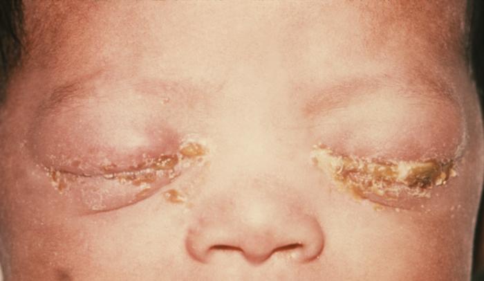 Newborn with gonococcal ophthalmia neonatorum caused by a maternally transmitted gonococcal infection.