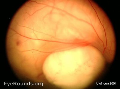 Example of Retinoblastoma 