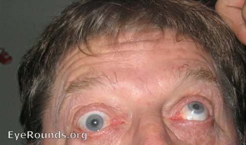 Man with left hypertropia