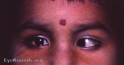child with left esotropia