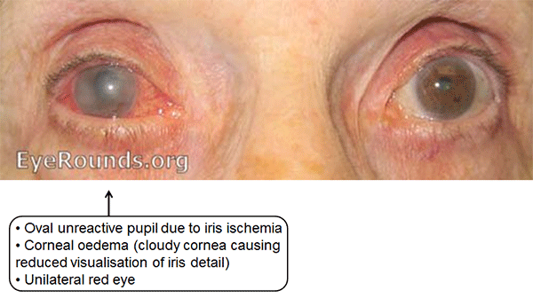 aac-glaucoma