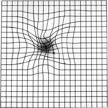 Example of Amsler distortion