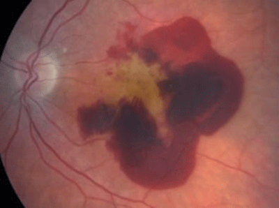 Wet AMD with haemorrhage from neovascularization