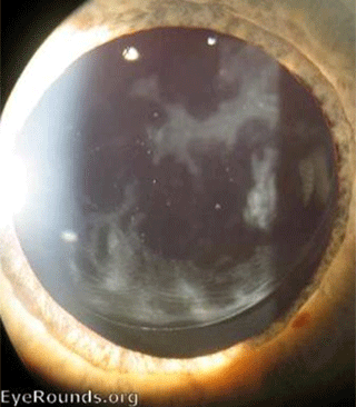 Slit lamp showing  a membrane forming behind  the intra ocular lens.