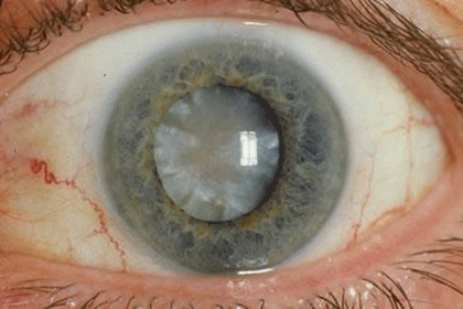 eye with cataract