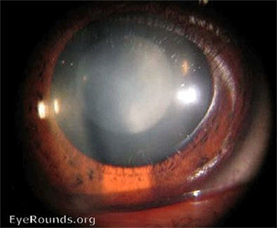 Eye with congenital cataract