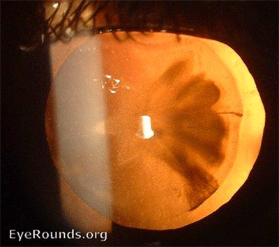 Traumatic rosette cataract seen in retro illumination (against the fundal red reflex) on the slit lamp