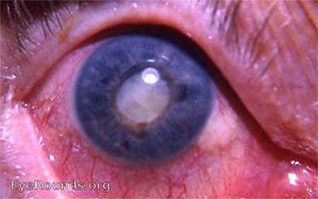 Eye with Uveitis