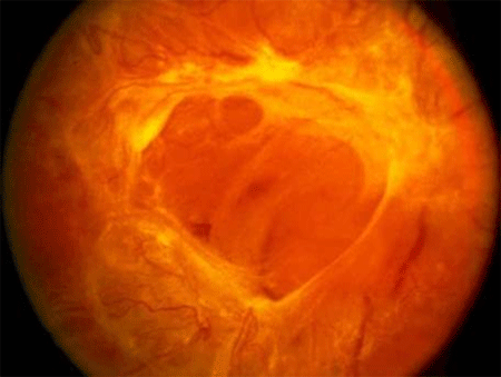 Tractional Retinal Detachment