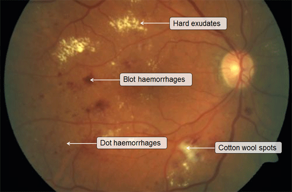 Retinal Signs