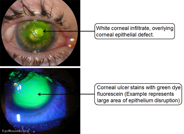 bacterial keratitis