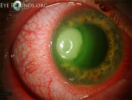 bacterial-keratitis