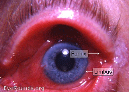 hyperaemia