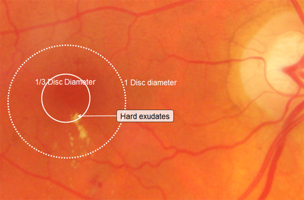 Macular Oedema