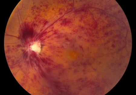 Retinal Vein Occlusion
