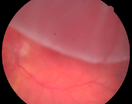 retina image for bullous superior retinal detachment