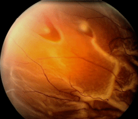 retina image for horseshoe tear far periphery