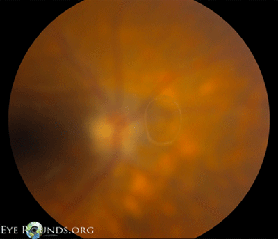 Weiss Ring: large floater seen following a posterior vitreous detachment.