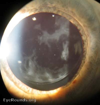 Slit lamp showing a membrane forming behind the intra ocular lens.