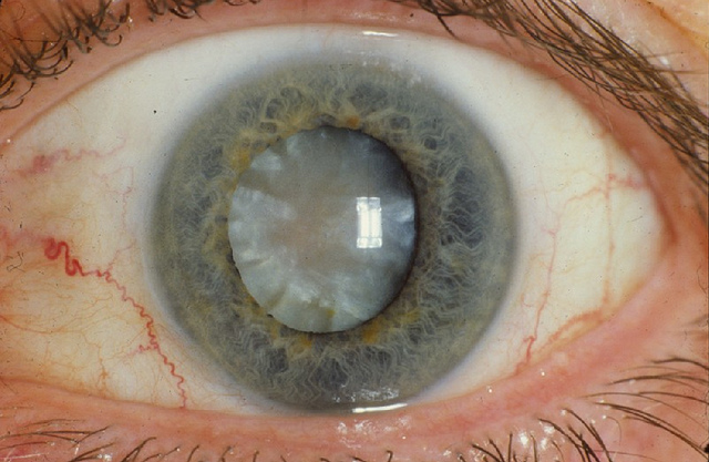 Eye with nuclear & cortical cataract