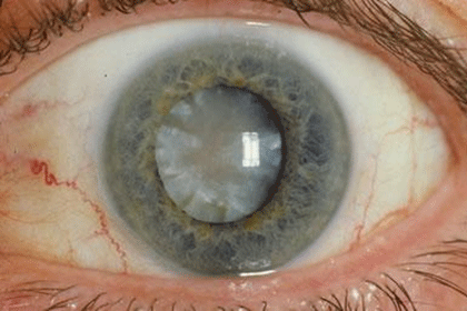 A hypermature age-related cortico-nuclear cataract with a brunescent (brown) nucleus.