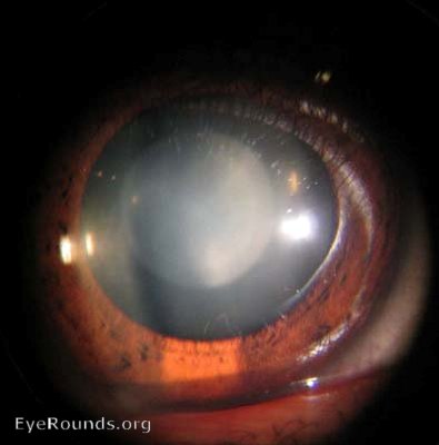 Eye with congenital cataract