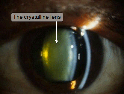 the crystalline lens