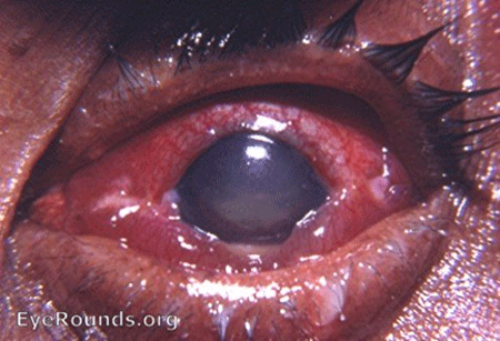 eye with endophthalmitis
