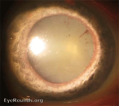 Eye with age-related Nuclear Sclerosis
