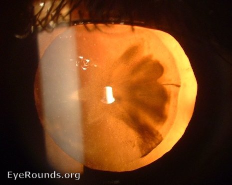 Traumatic rosette cataract seen in retro illumination (against the fundal red reflex) on the slit lamp