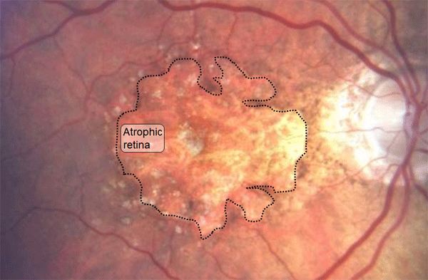 Atrophic retina in Dry AMD
