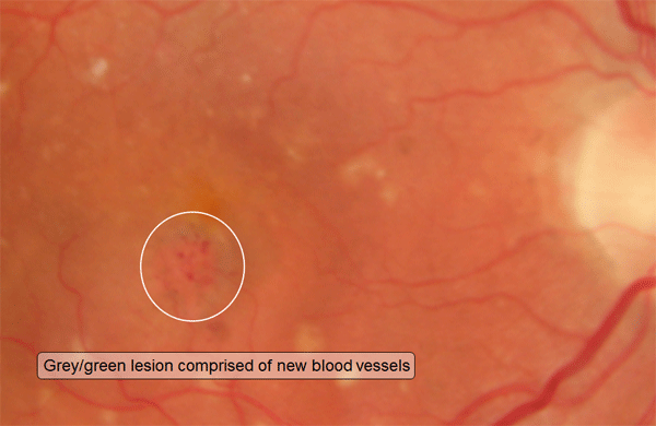 Choroidal Neovacularization: Grey/green lesion consisting of new blood vessels