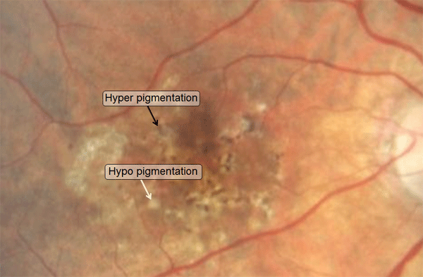 hyper and hypo pigmentation