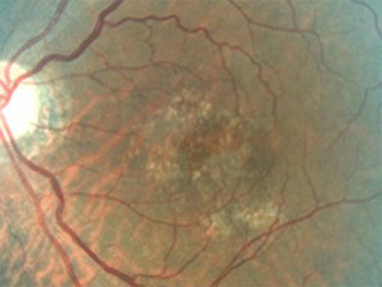 Retina image of dry AMD