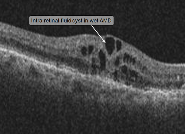 Optical coherence tomography showing intra retinal fluid cyst in wet AMD