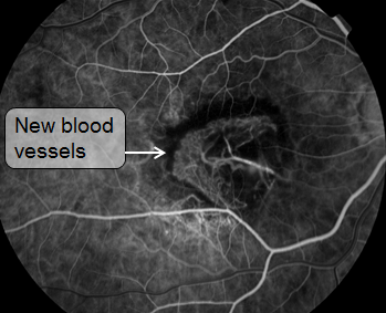 fluorescein angiography showing new blood vessels