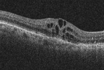 optical coherence tomography