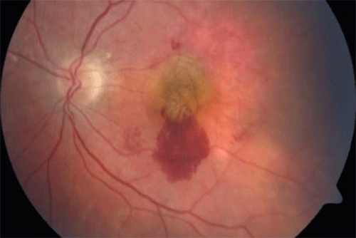 Retinal haemorrhage